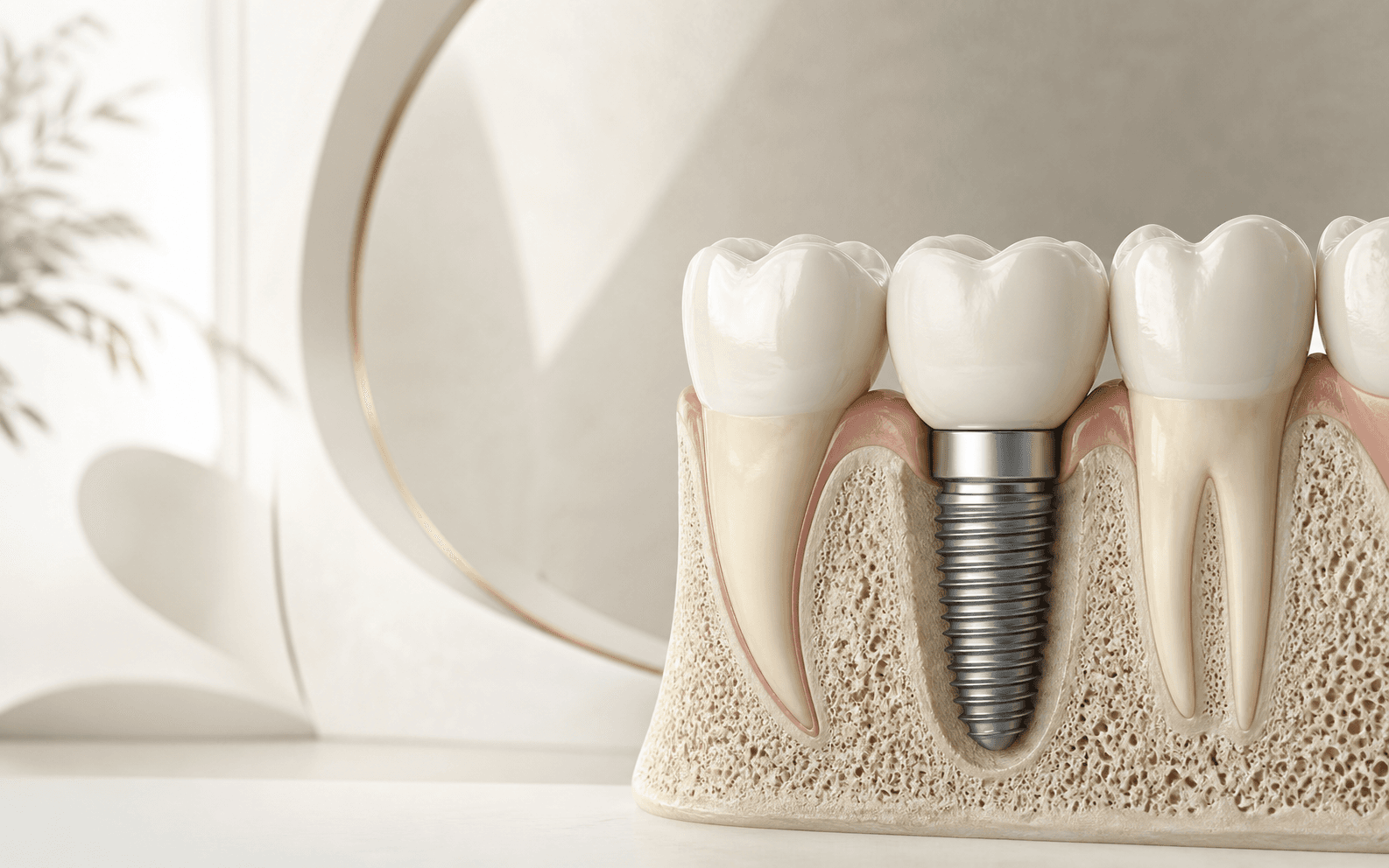 Implant dentaire intégré dans l’os et portant une couronne en céramique